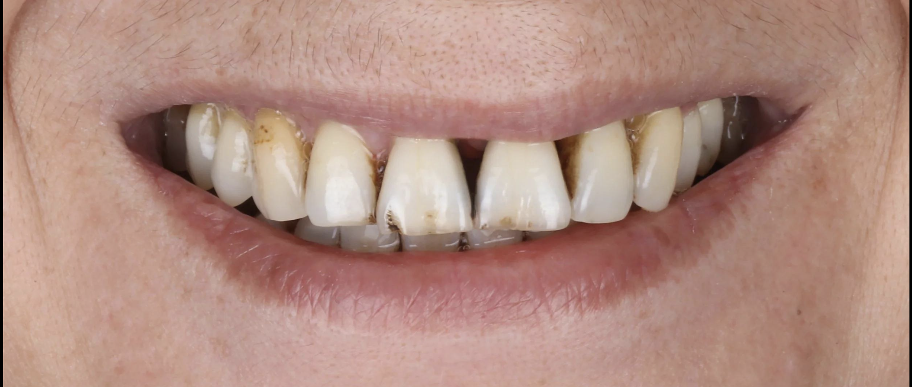 Antes del tratamiento de implantes