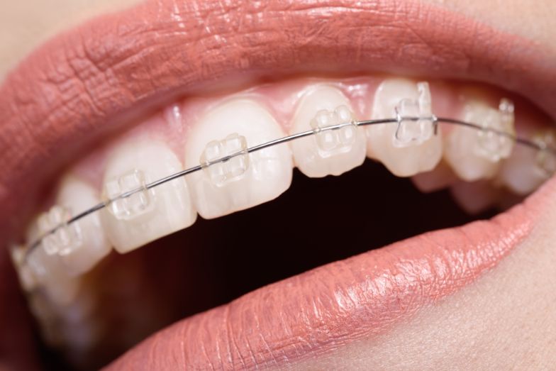 Brackets estéticos de zafiro