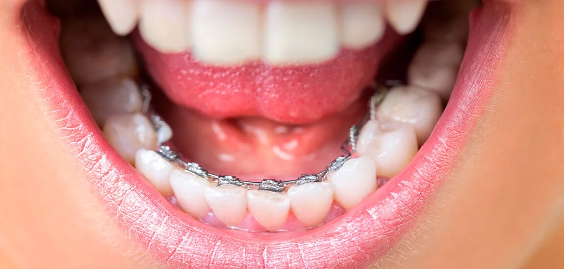 Brackets linguales ortodoncia