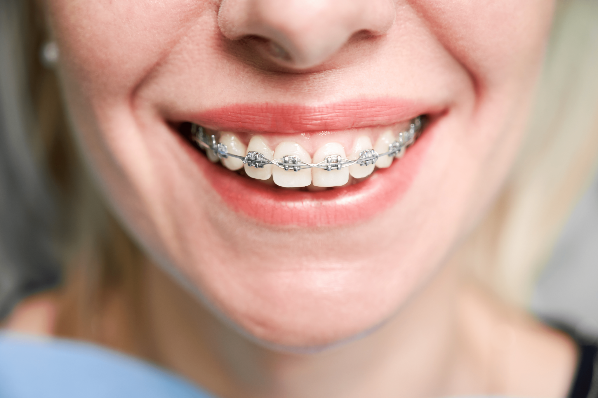 Brackets metálicos ortodoncia